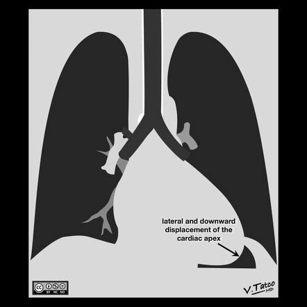 lv enlargement radiopaedia